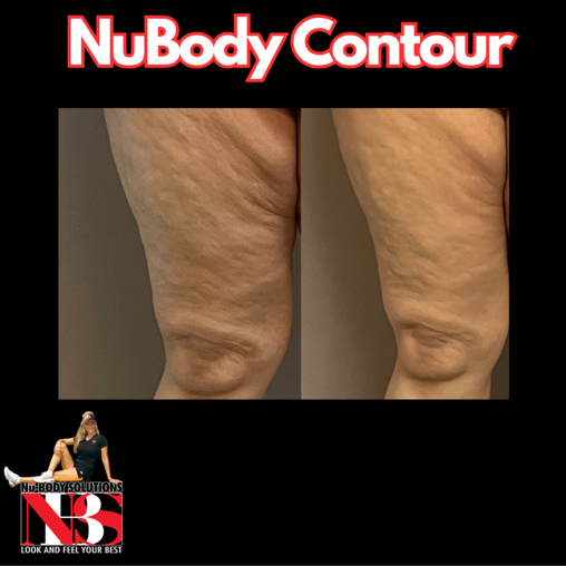 Greensboro Body Contouring | NuBody Solutions